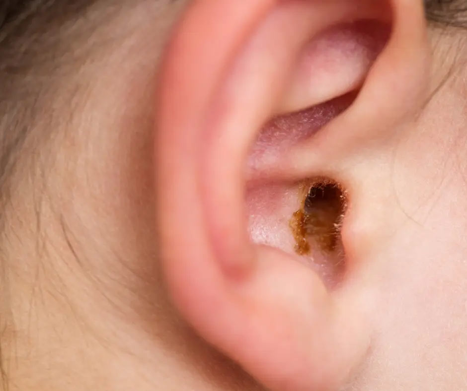 An ear with visible ear wax showing. 